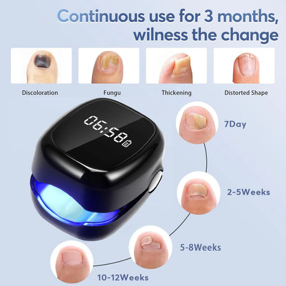 Eliminate Nail Fungus with White/Black Laser Treatment Device!